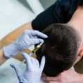 Hair Restoration In Beverly Hills: The Ultimate Guide For Reversing Hair Loss After Laser Hair Removal