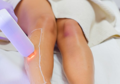 What are the negatives of laser hair removal?